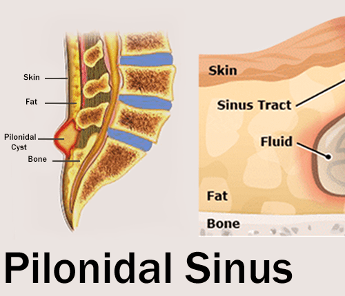 Pilonidal-Sinus (1) (1)-min